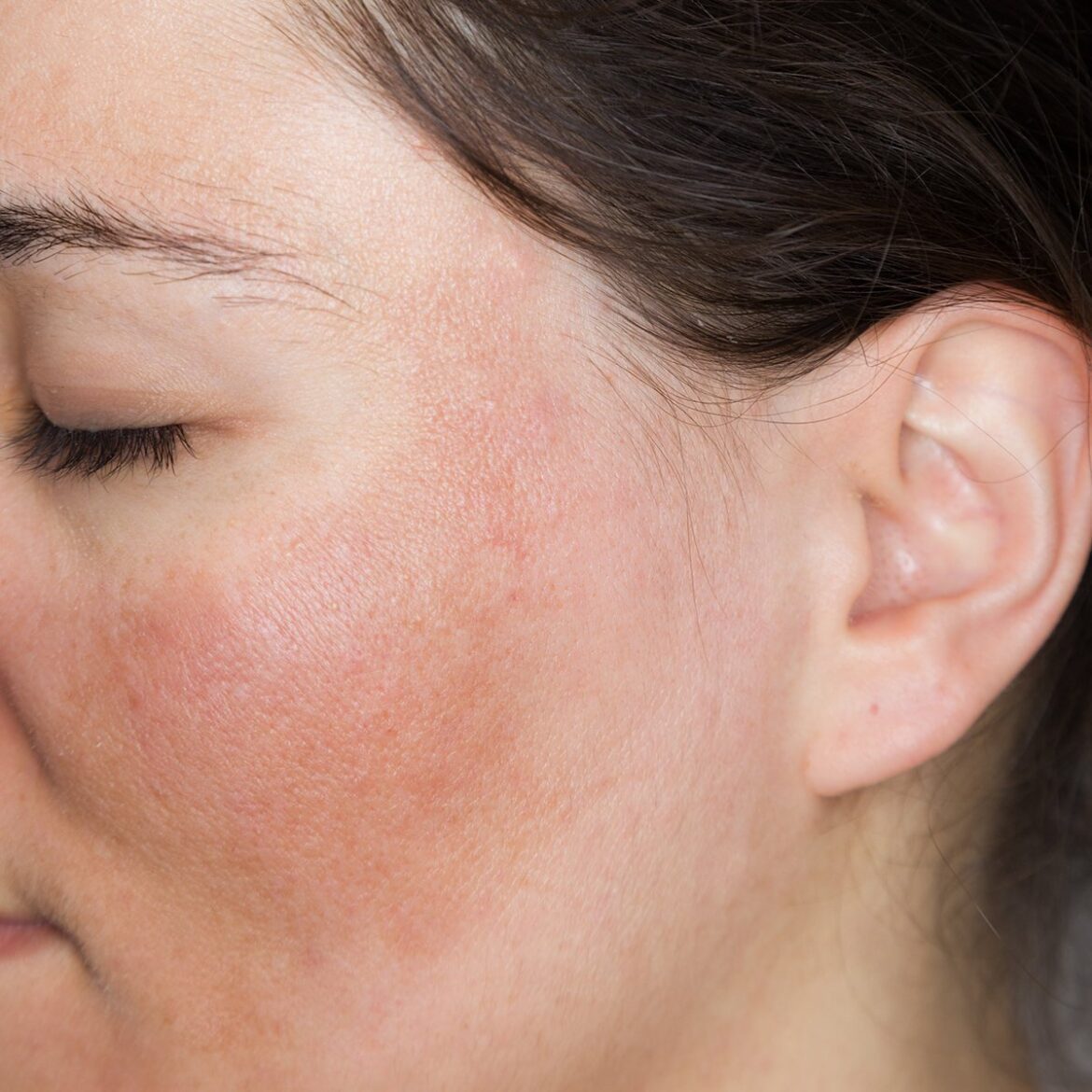 What is Melasma, the ‘Mask of Pregnancy’? – Tropic Skincare What is Melasma, the ‘Mask of Pregnancy’? – Tropic Skincare