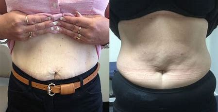 Does Bariatric Surgery Leave Scars?