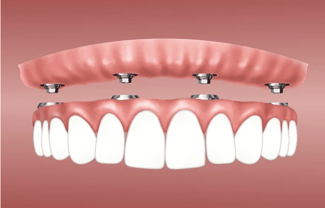 Dental Implant Procedure Dental Implant Procedure